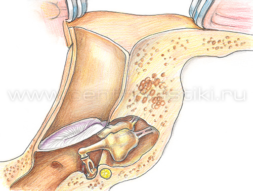 Хронический отит