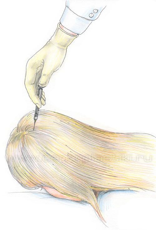 Мезотерапия волос