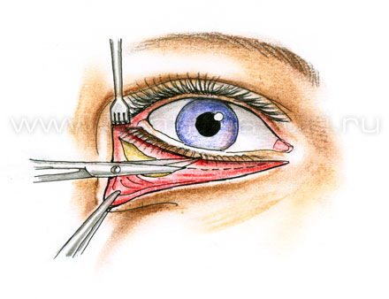 Подтяжка средней зоны лица