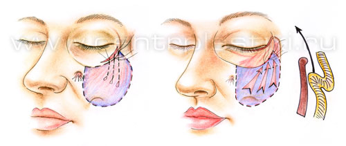 Подтяжка средней зоны лица