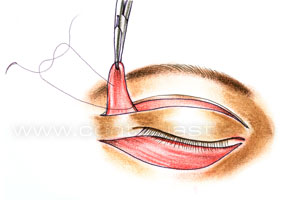 Подтяжка средней зоны лица