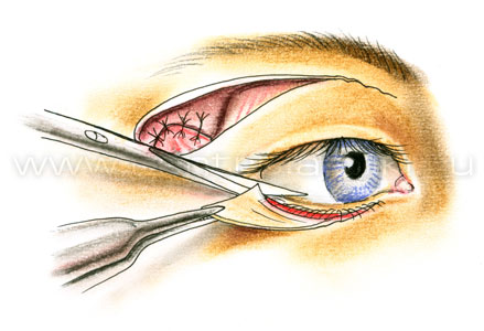 Подтяжка средней зоны лица