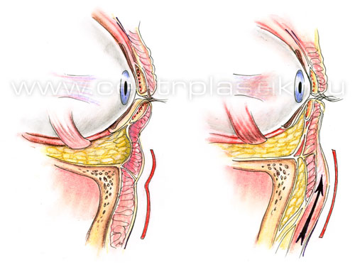 Подтяжка средней зоны лица