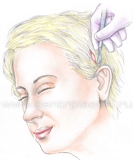 Подтяжка лица нитями