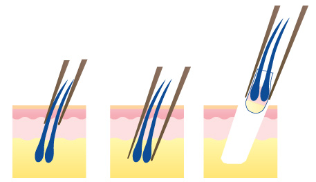 Пересадка волос