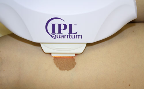 Удаление пигментных пятен лазером