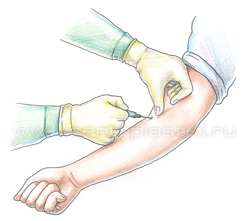 Плазмолифтинг