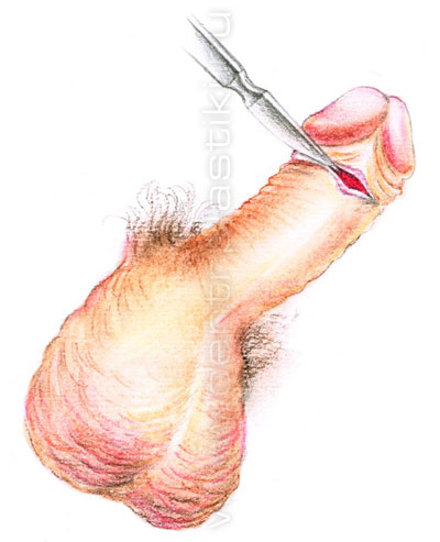 Пластика уздечки полового члена