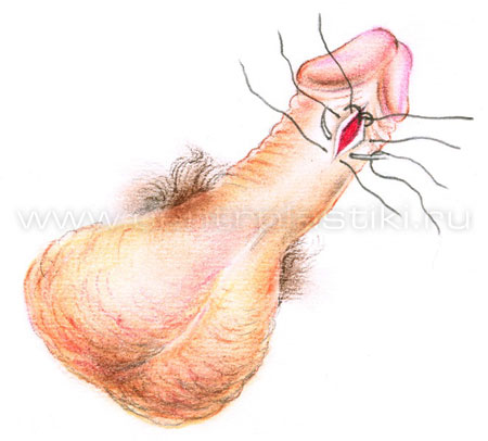 Пластика уздечки полового члена