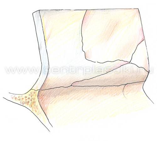 Искривление носовой перегородки