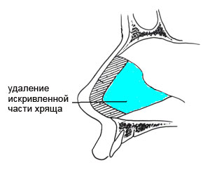 Искривление носовой перегородки