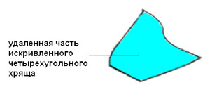 Искривление носовой перегородки