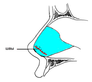 Искривление носовой перегородки