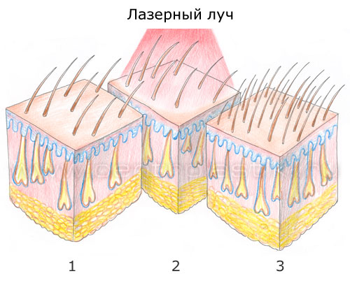 Лечение волос лазером