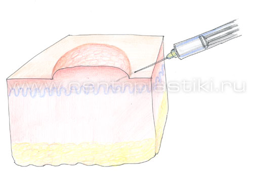 Удаление кератомы