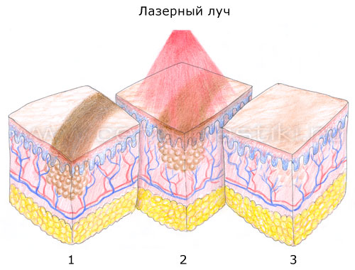Удаление перманентного макияжа