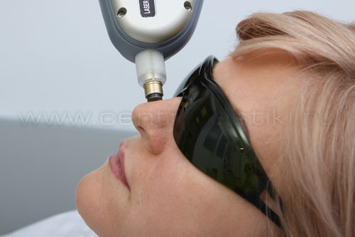 Удаление сосудов лазером