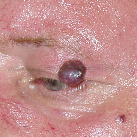 Гемангиома