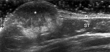 Гемангиома