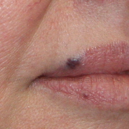 Гемангиома