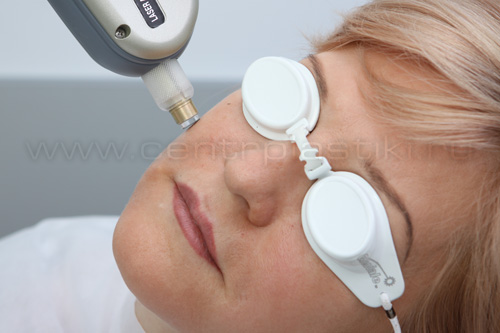 Гемангиома