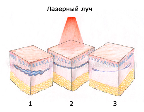 Гемангиома