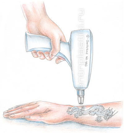 Удаление татуировок