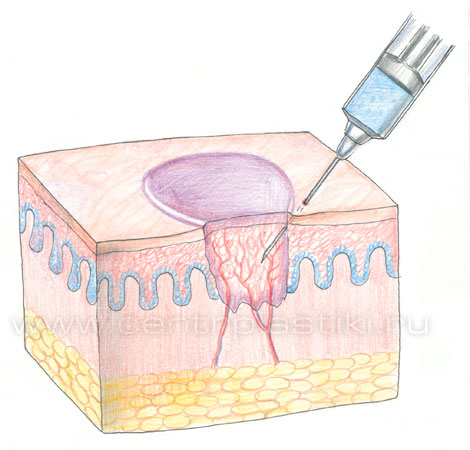 Контагиозный моллюск