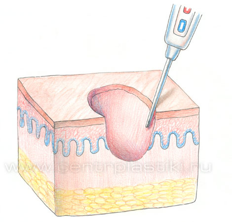 Контагиозный моллюск