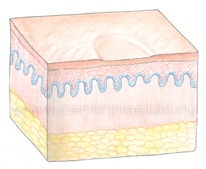 Контагиозный моллюск