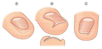 Вросший ноготь