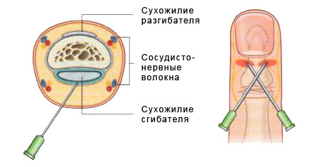 Вросший ноготь