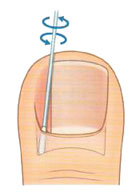Вросший ноготь