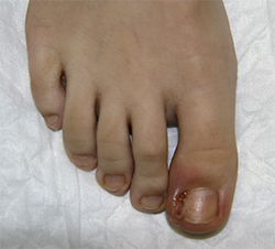 Вросший ноготь - фото