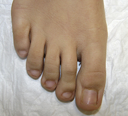 Вросший ноготь - фото