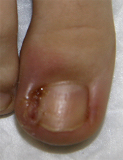 Вросший ноготь - фото до
